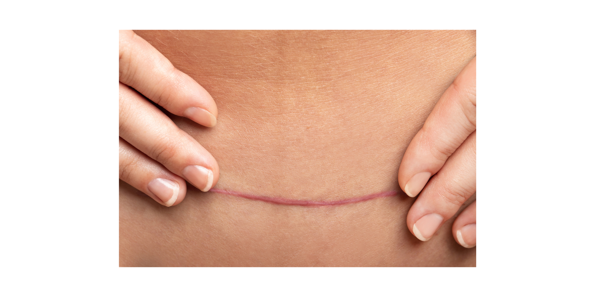 C-Section Recovery Shapewear